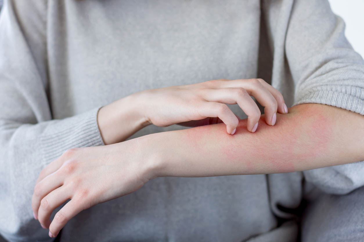 What Does Poison Sumac Look Like Sumac Causes Skin Rash