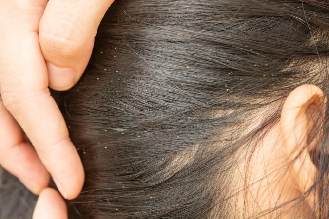 How to Get Rid of Lice