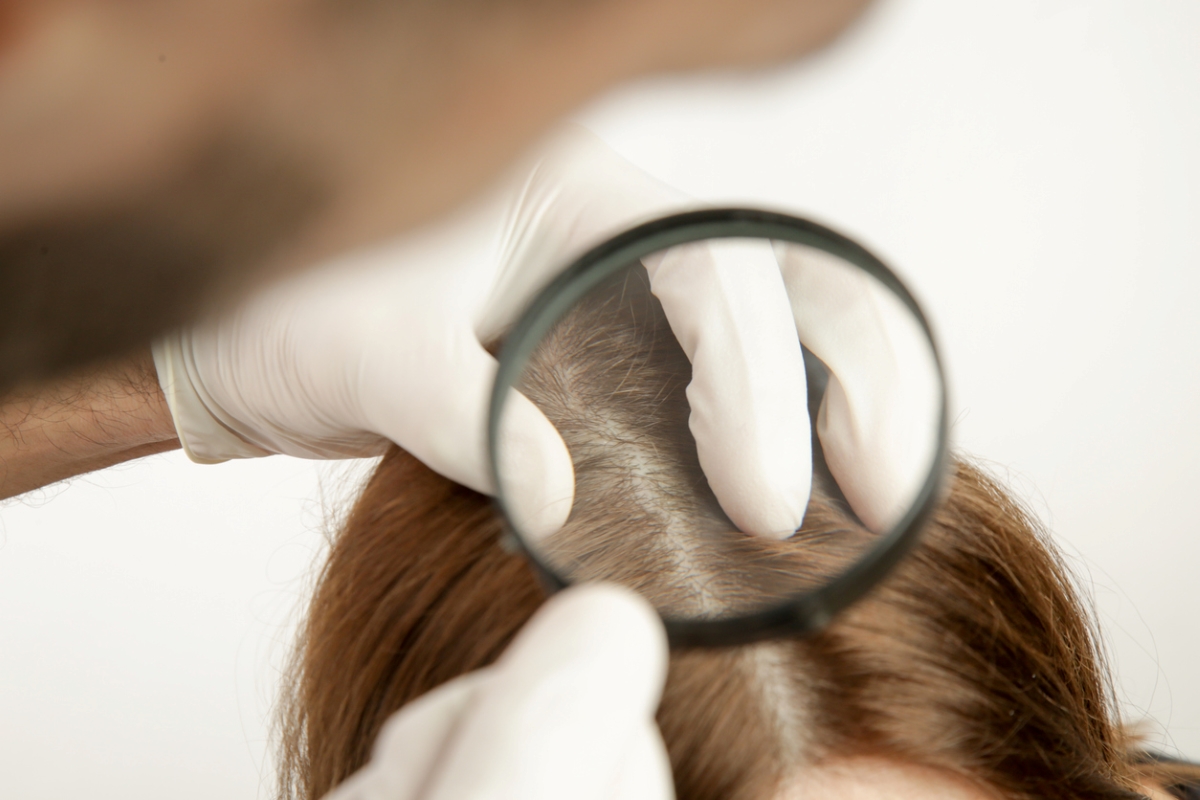 Person using magnifying glass to look at scalp