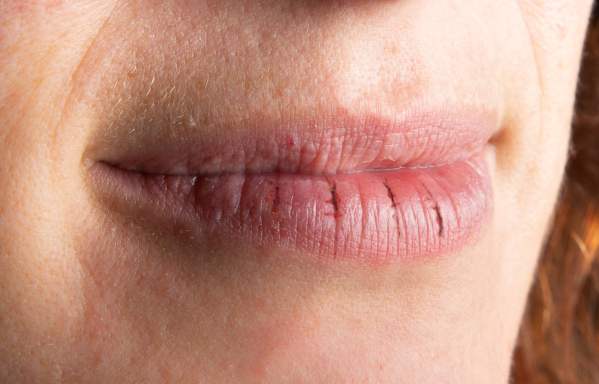 Close up view of a woman's cracked and chapped lips.