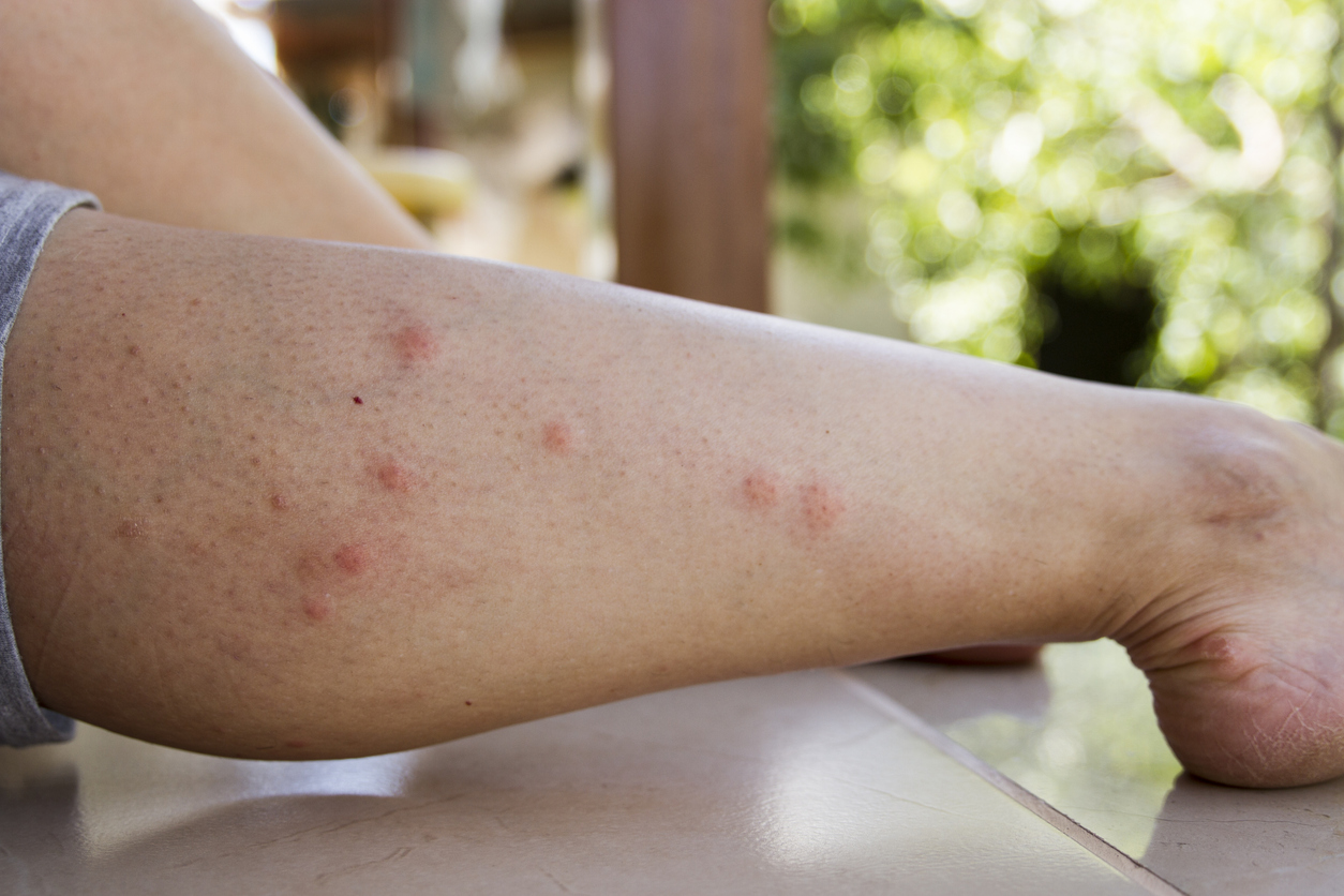 Mosquito bites on leg.